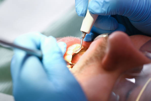 Best Emergency Treatment for Dental Infections or Abscesses in Independent Hill, VA