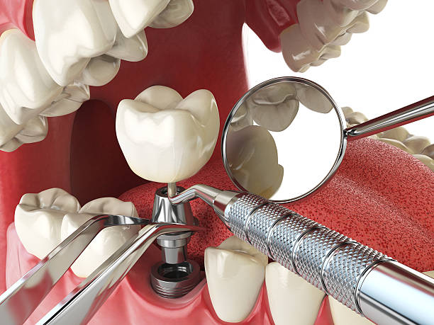 Best Emergency Tooth Extraction in Independent Hill, VA